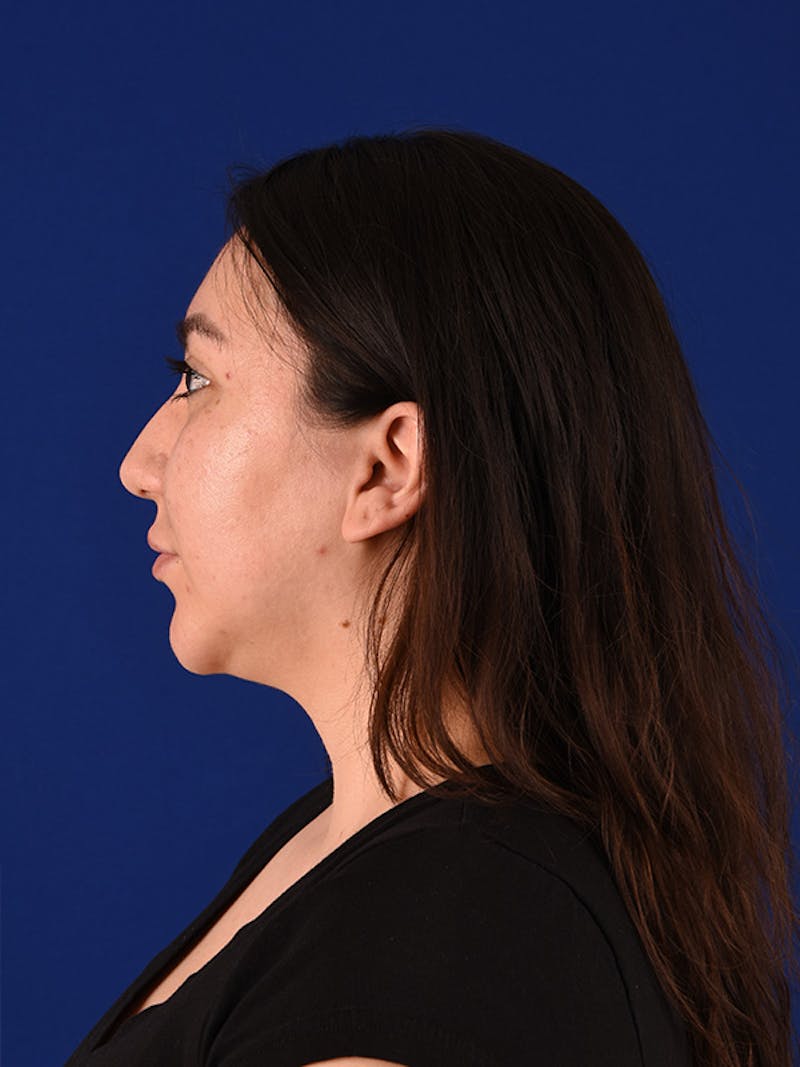 Female Rhinoplasty Before & After Gallery - Patient 122145471 - Image 5