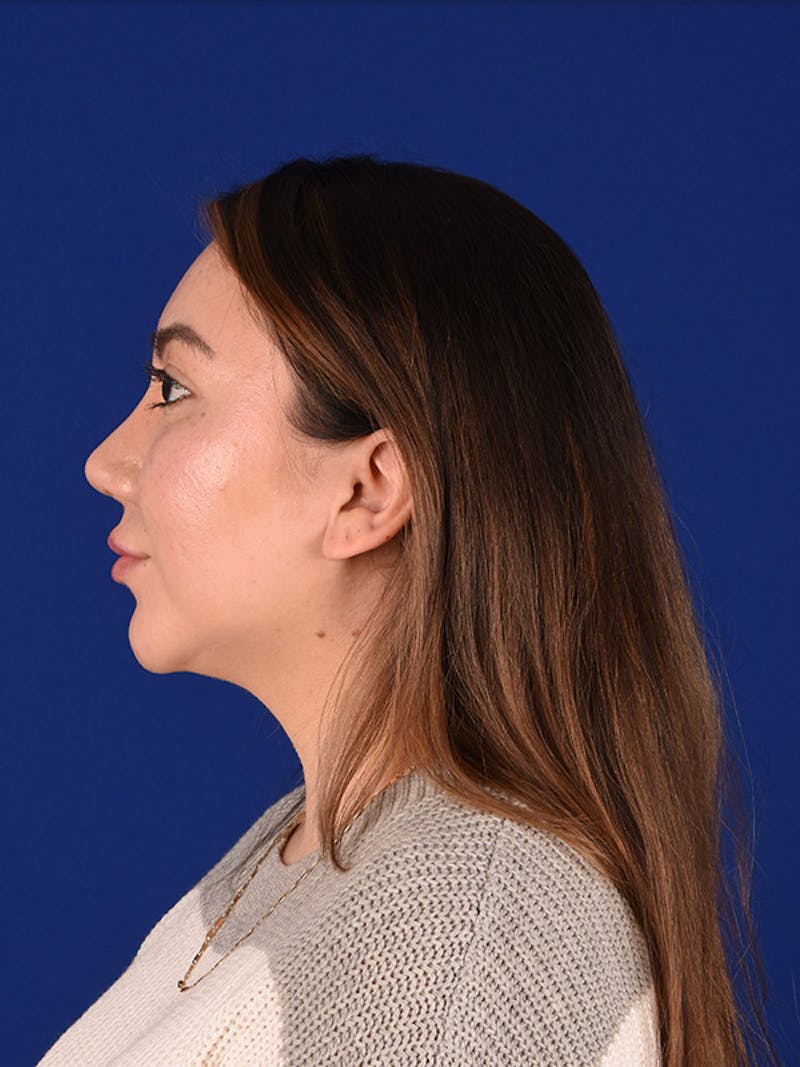 Female Rhinoplasty Before & After Gallery - Patient 122145471 - Image 6
