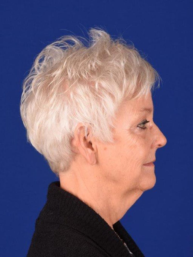 Facelift Before & After Gallery - Patient 162082252 - Image 5