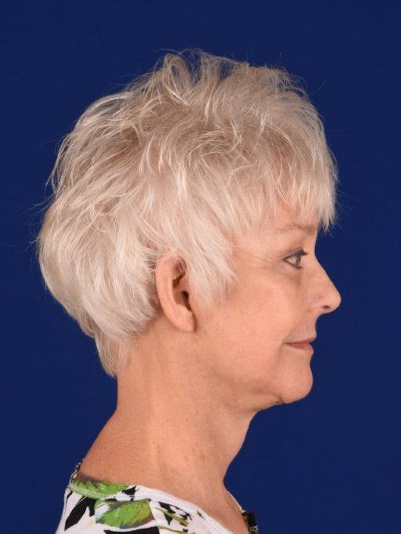 Facelift Before & After Gallery - Patient 162082252 - Image 6