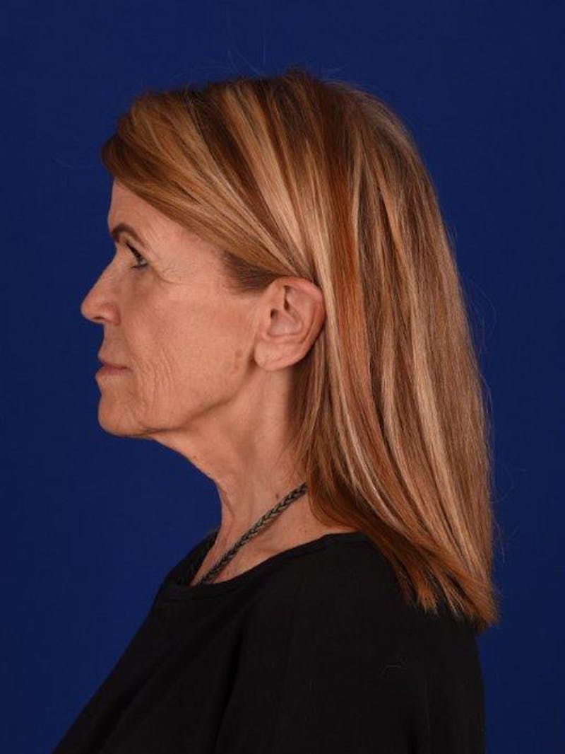 Facelift Before & After Gallery - Patient 162082285 - Image 5