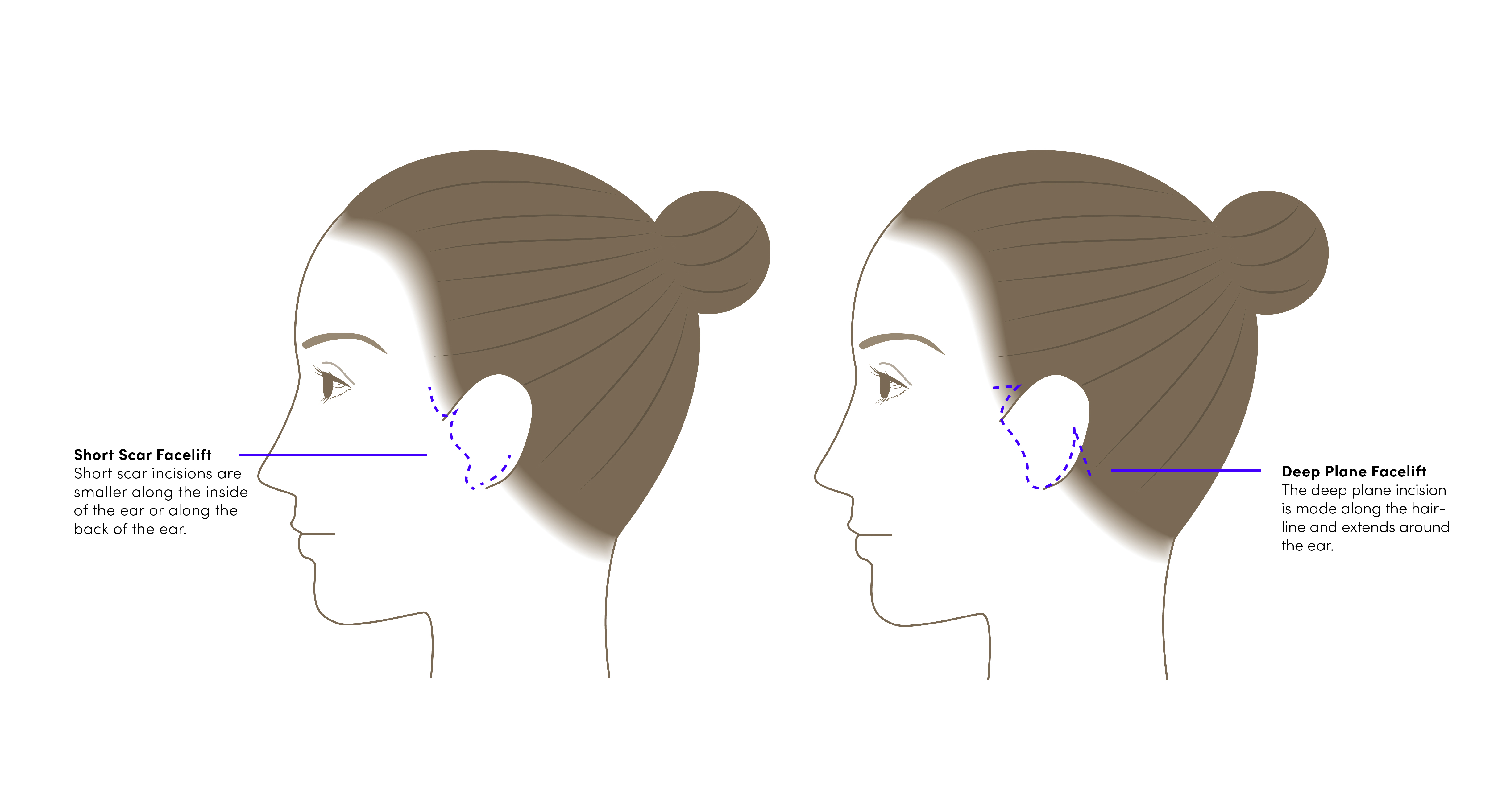 Graphic Showing the Incision for a Short Scar Facelift and Deep Plane Facelift