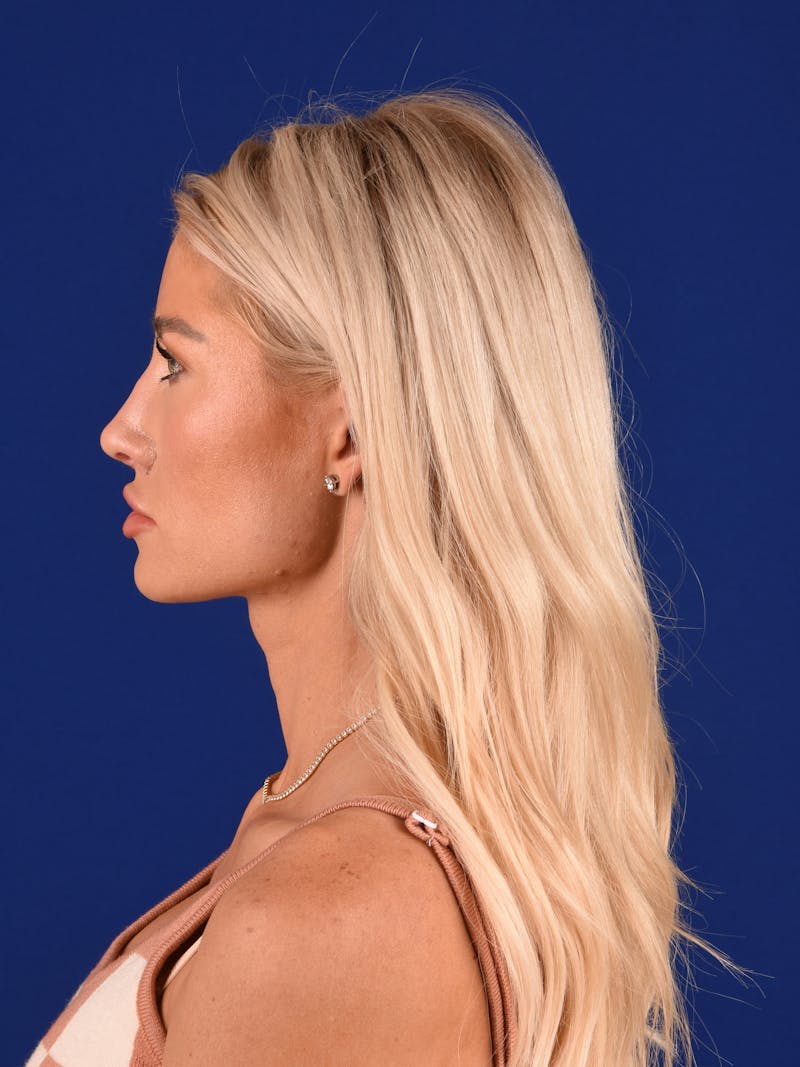 Female Rhinoplasty Before & After Gallery - Patient 424969 - Image 4