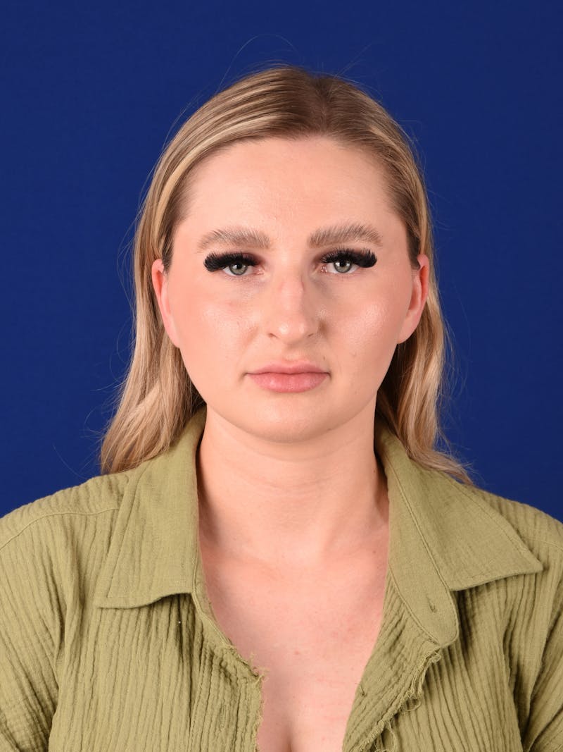 Female Rhinoplasty Before & After Gallery - Patient 243543 - Image 1