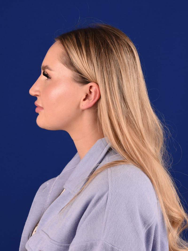 Female Rhinoplasty Before & After Gallery - Patient 243543 - Image 6