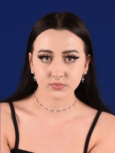 Female Rhinoplasty Before & After Gallery - Patient 199805 - Image 1