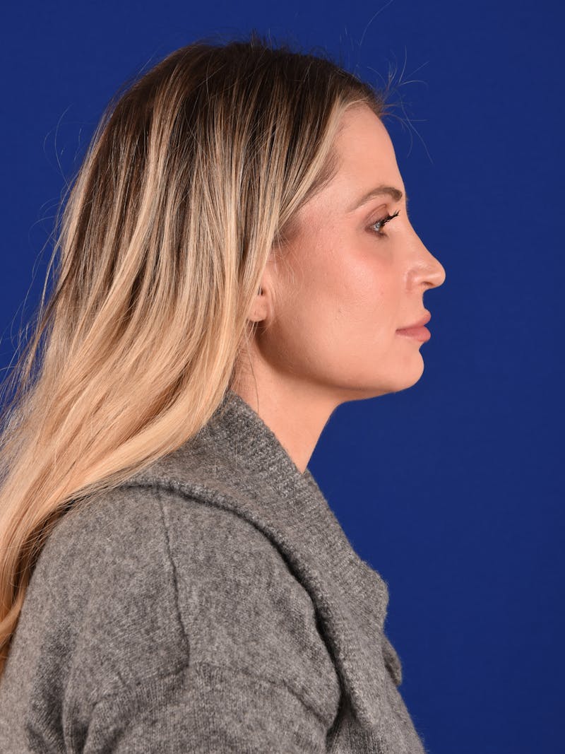 Female Rhinoplasty Before & After Gallery - Patient 290028 - Image 6