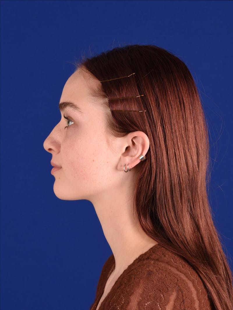 Female Rhinoplasty Before & After Gallery - Patient 269976 - Image 5