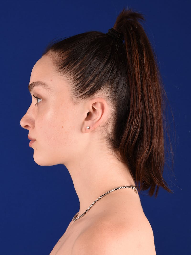 Female Rhinoplasty Before & After Gallery - Patient 269976 - Image 6