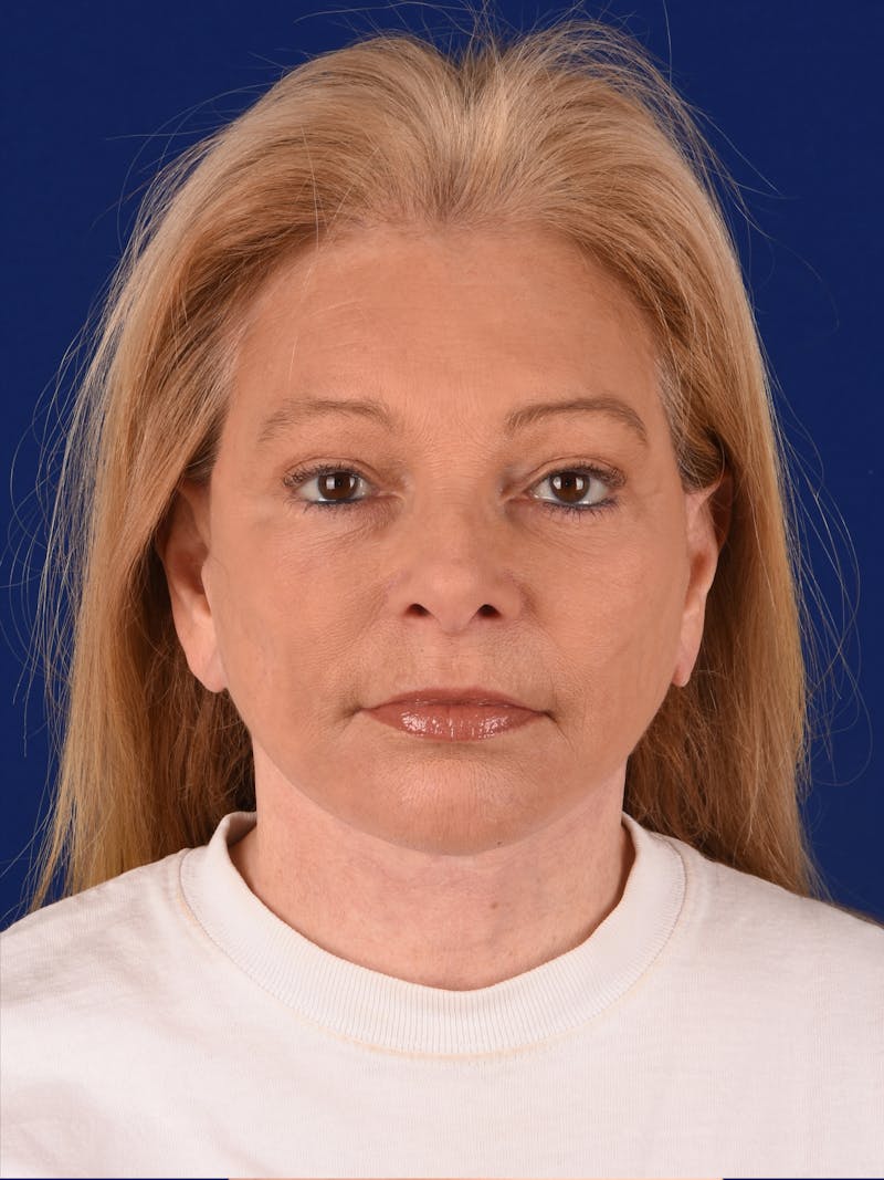 Facelift Before & After Gallery - Patient 376122 - Image 2