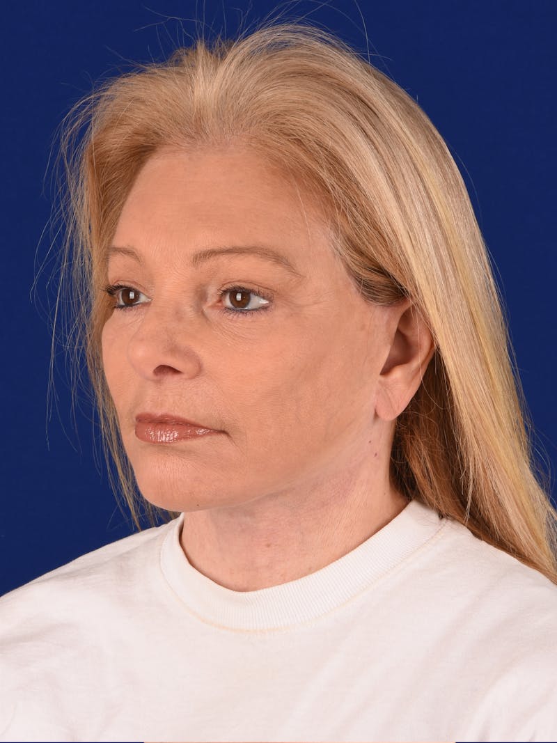 Facelift Before & After Gallery - Patient 376122 - Image 4
