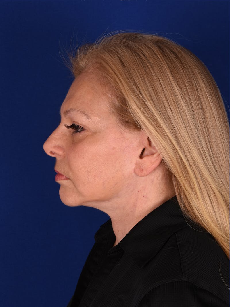 Facelift Before & After Gallery - Patient 376122 - Image 5