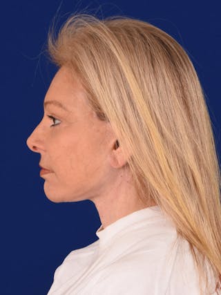 Facelift Before & After Gallery - Patient 376122 - Image 6