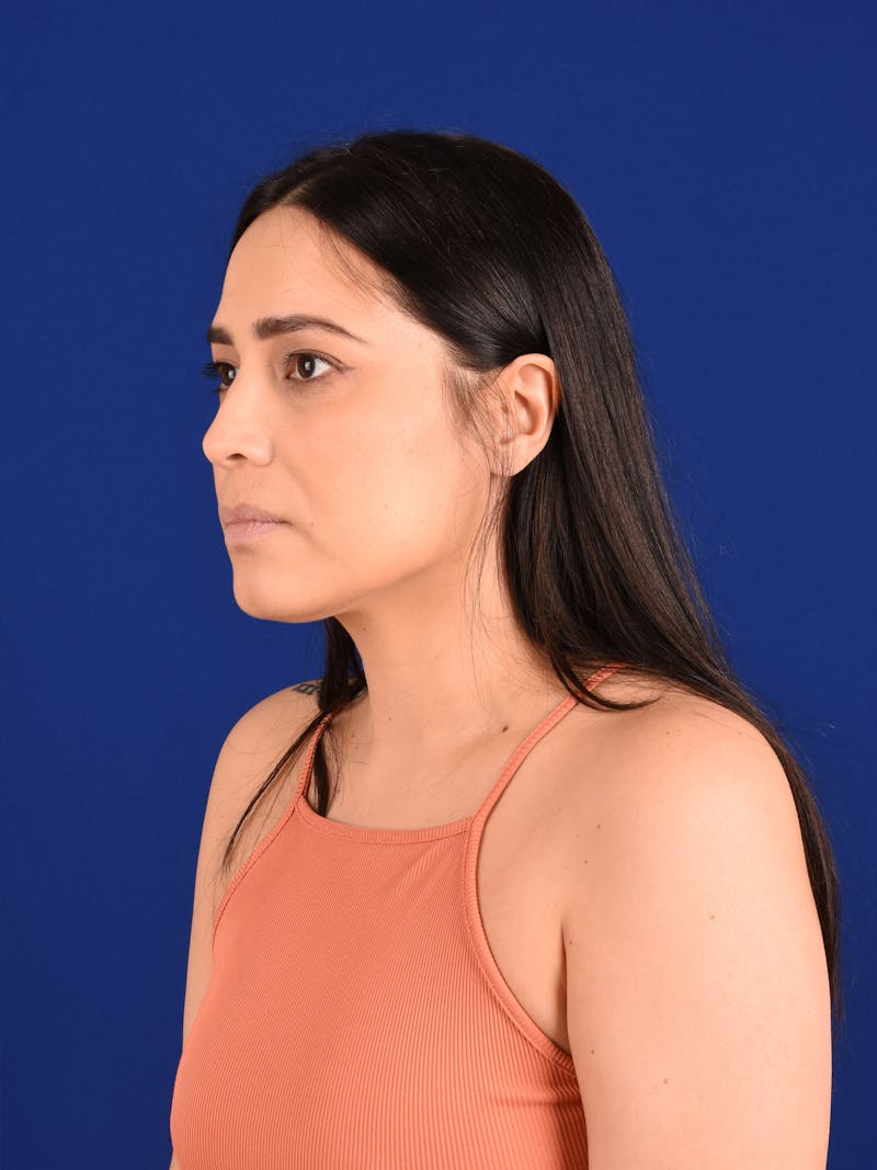 Female Rhinoplasty Before & After Gallery - Patient 261732 - Image 3
