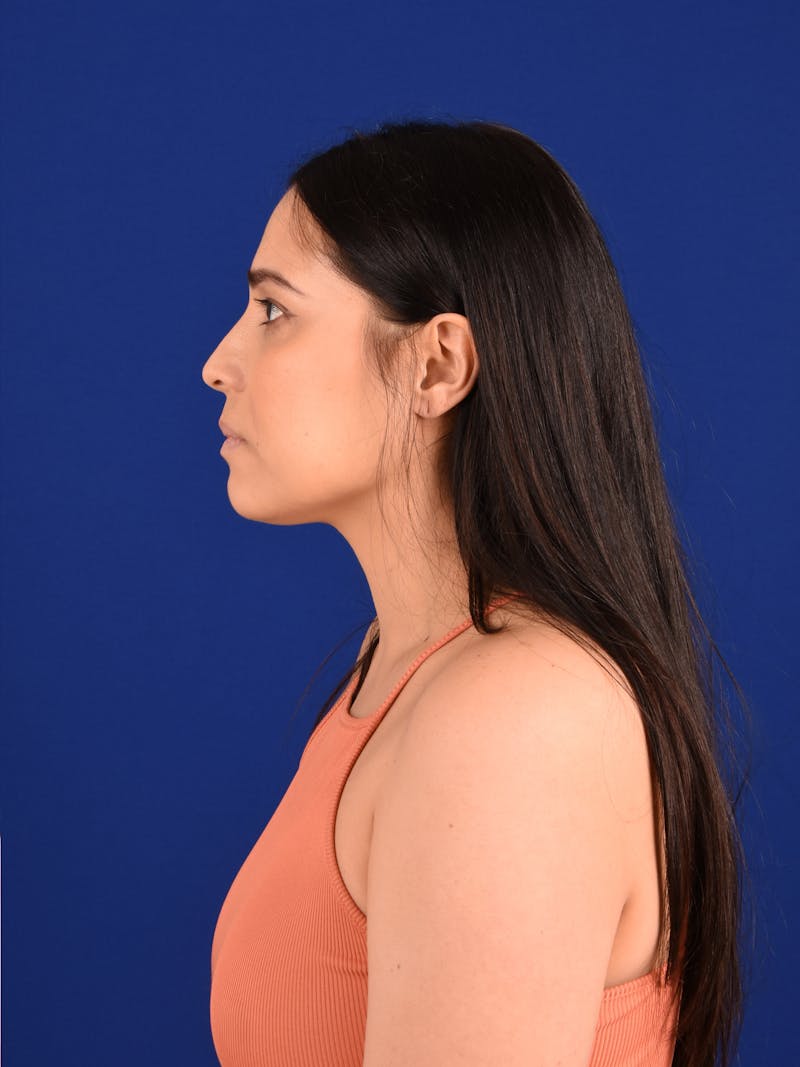 Female Rhinoplasty Before & After Gallery - Patient 261732 - Image 5
