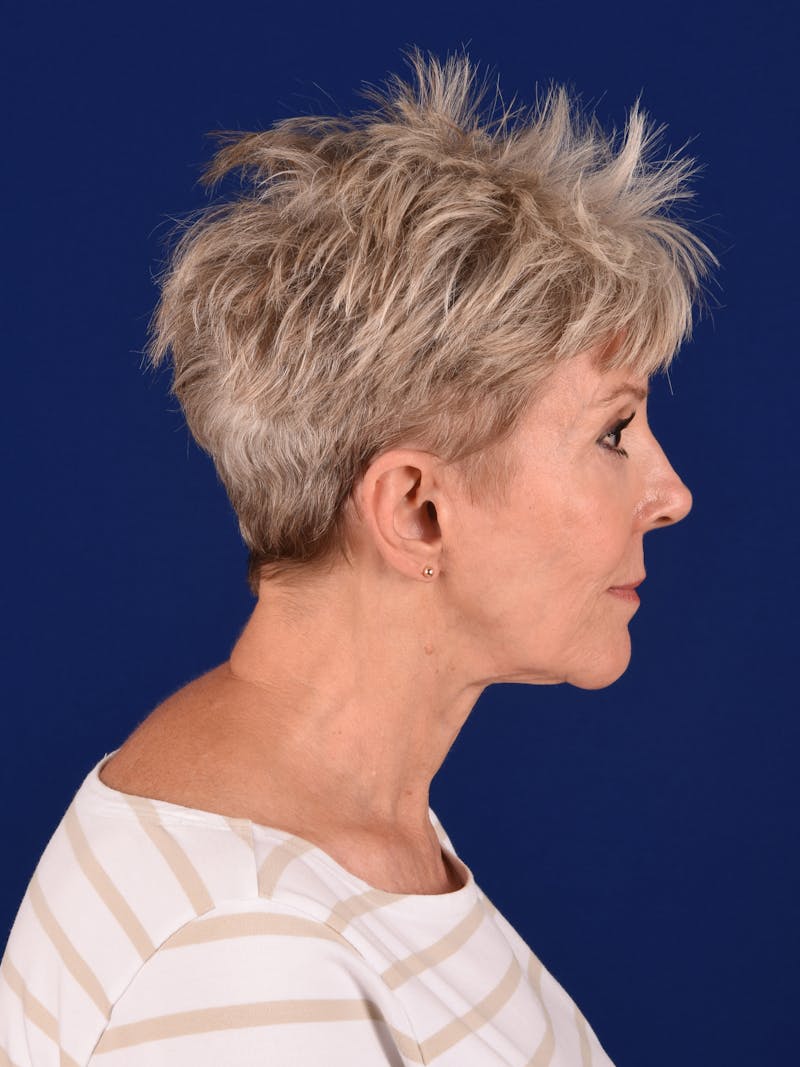 Facelift Before & After Gallery - Patient 291512 - Image 5
