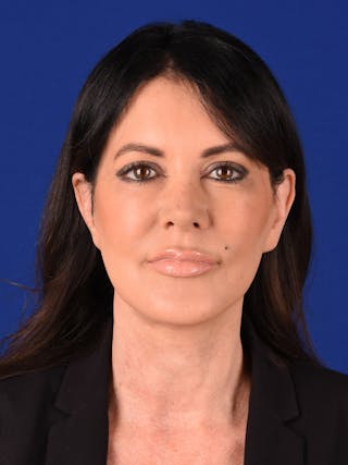 Facelift Before & After Gallery - Patient 241160 - Image 2