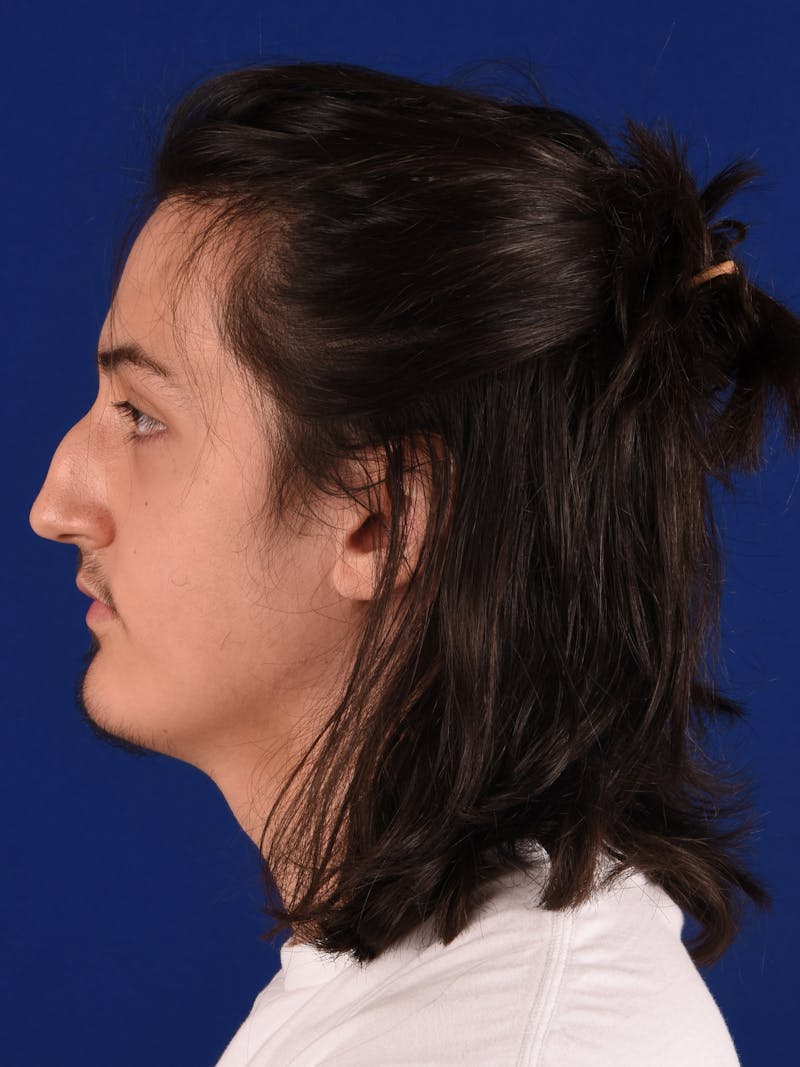 Rhinoplasty Before & After Gallery - Patient 232885 - Image 5