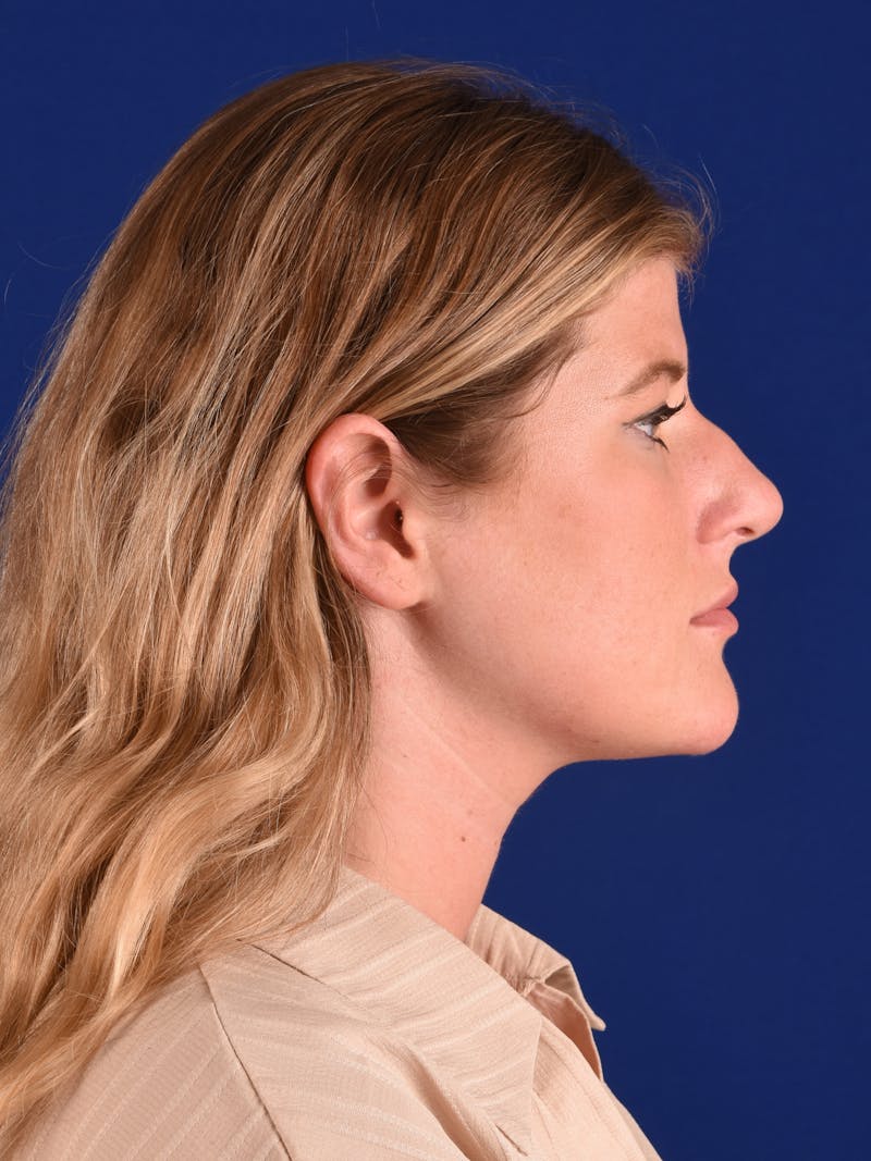 Female Rhinoplasty Before & After Gallery - Patient 322714 - Image 5