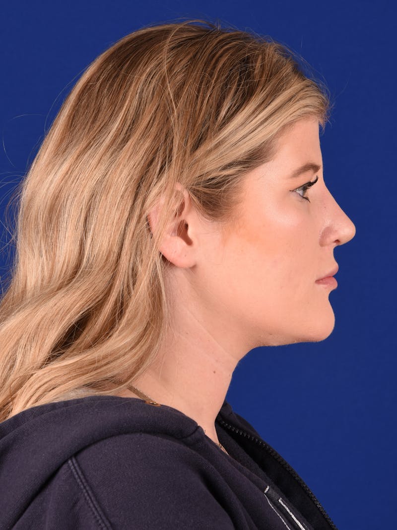 Female Rhinoplasty Before & After Gallery - Patient 322714 - Image 6