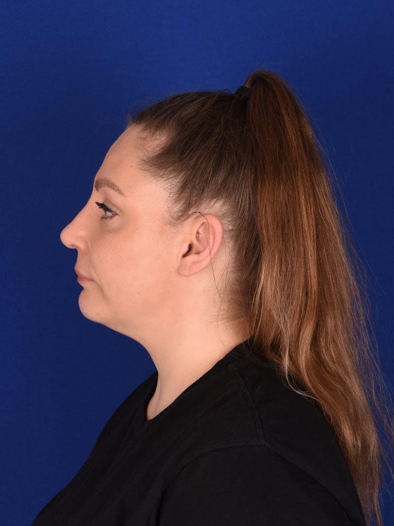Female Rhinoplasty Before & After Gallery - Patient 332045 - Image 6