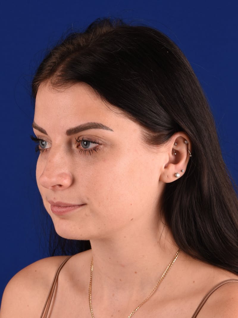 Female Rhinoplasty Before & After Gallery - Patient 921606 - Image 3