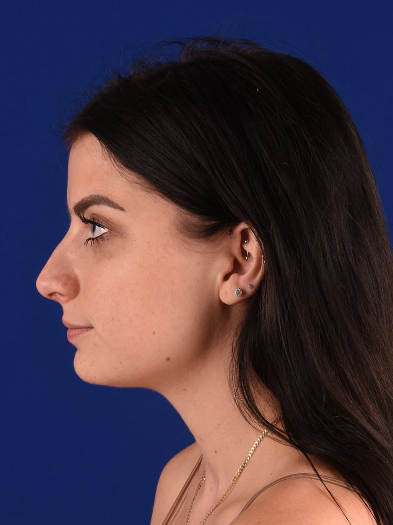 Female Rhinoplasty Before & After Gallery - Patient 921606 - Image 5