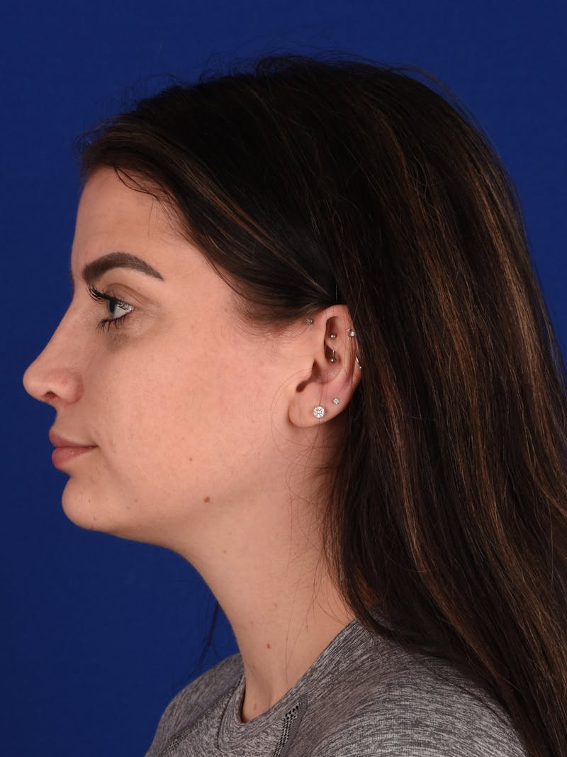 Female Rhinoplasty Before & After Gallery - Patient 921606 - Image 6