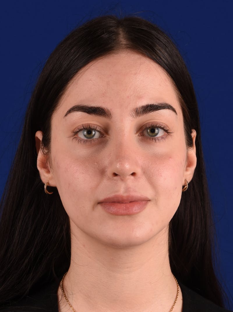 Female Rhinoplasty Before & After Gallery - Patient 265348 - Image 2