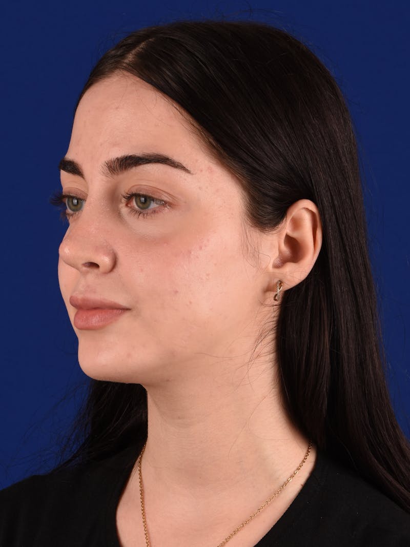 Female Rhinoplasty Before & After Gallery - Patient 265348 - Image 4