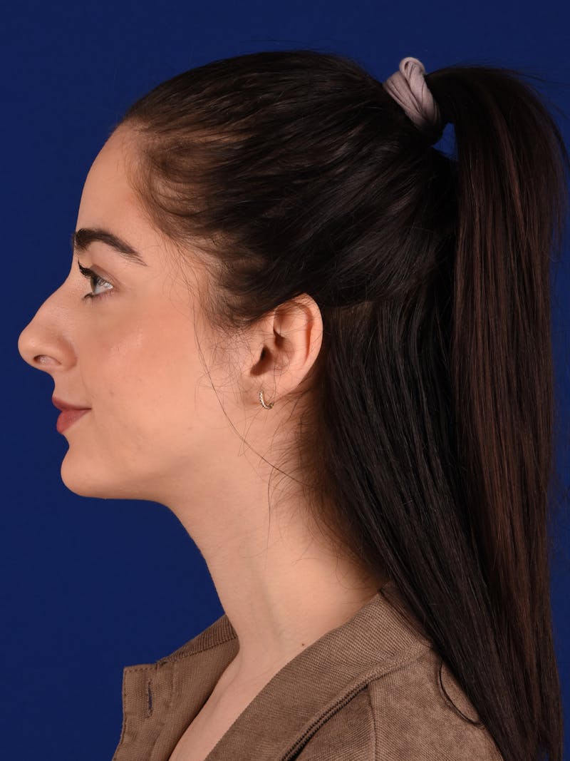 Female Rhinoplasty Before & After Gallery - Patient 265348 - Image 5