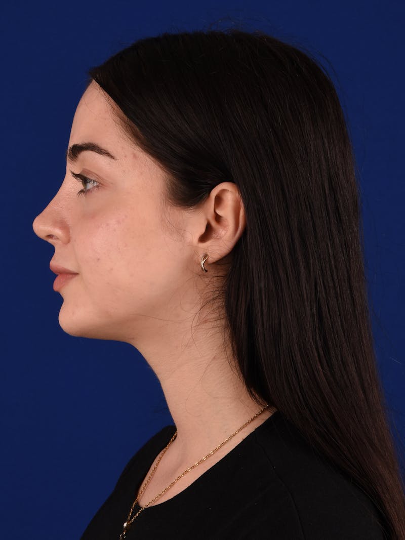 Female Rhinoplasty Before & After Gallery - Patient 265348 - Image 6