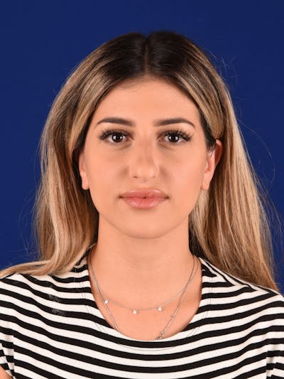 Female Rhinoplasty Before & After Gallery - Patient 323127 - Image 1