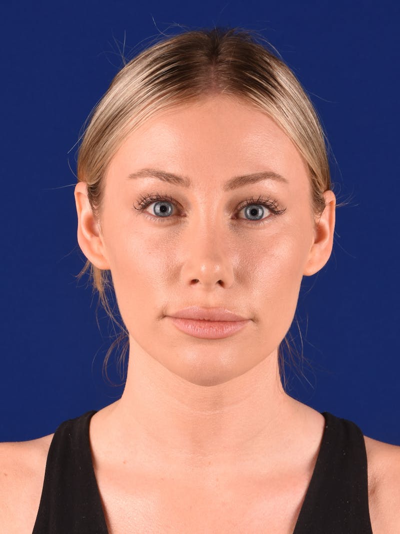 Female Rhinoplasty Before & After Gallery - Patient 130488 - Image 2