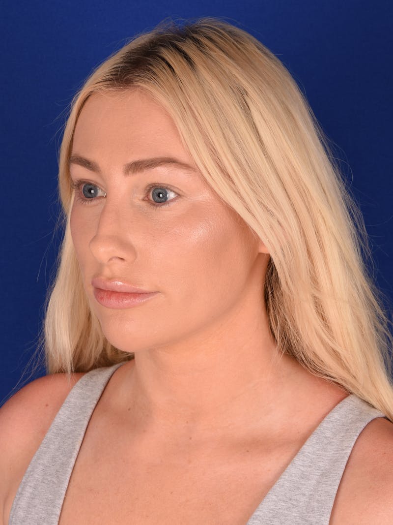 Female Rhinoplasty Before & After Gallery - Patient 130488 - Image 3