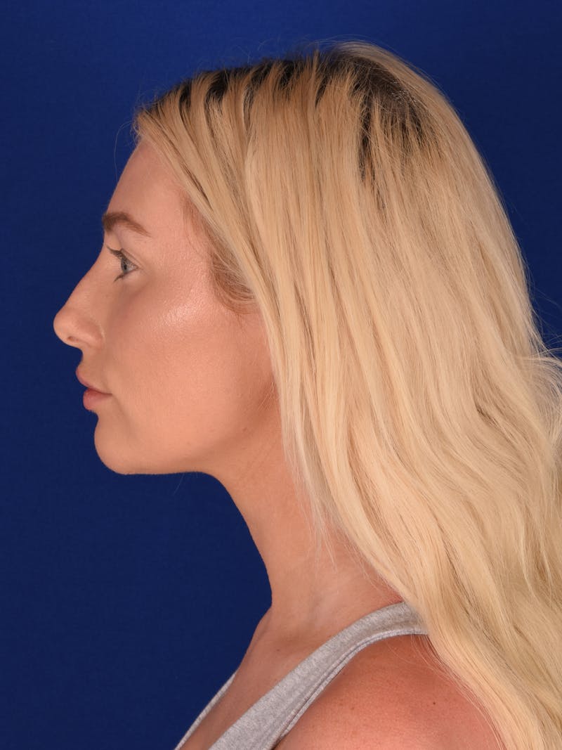 Female Rhinoplasty Before & After Gallery - Patient 130488 - Image 5