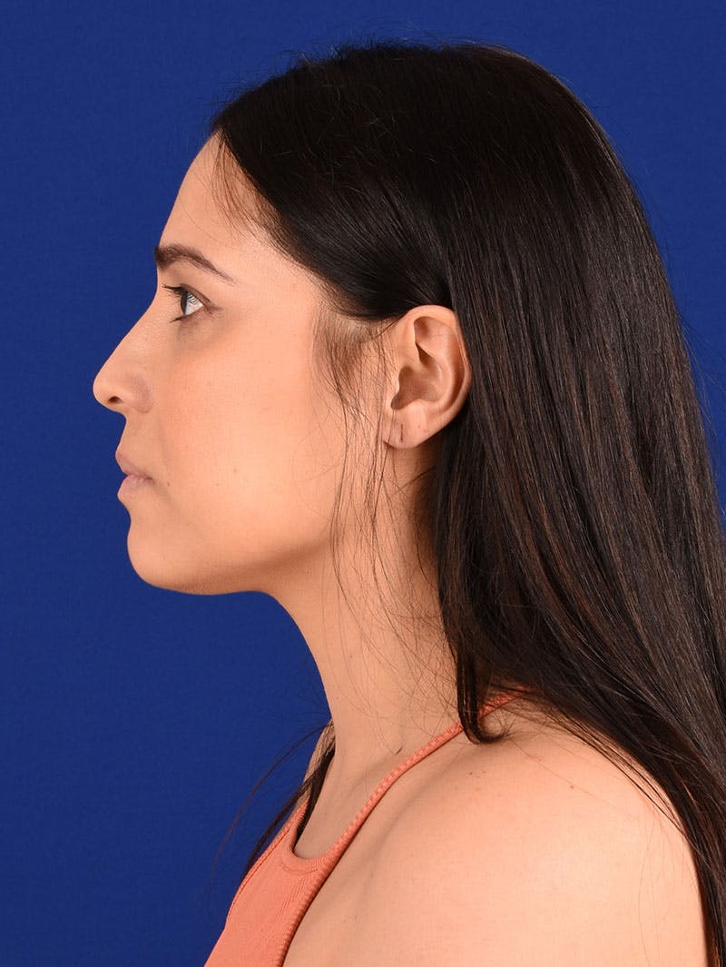 Female Rhinoplasty Before & After Gallery - Patient 261732 - Image 5