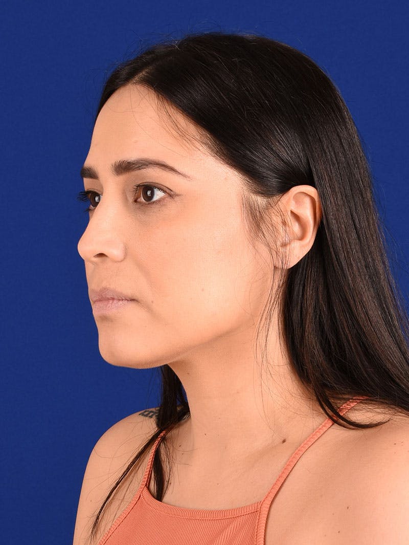 Female Rhinoplasty Before & After Gallery - Patient 261732 - Image 3