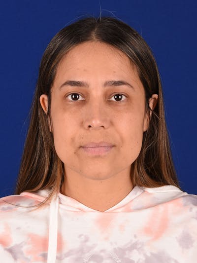 Female Rhinoplasty Before & After Gallery - Patient 261732 - Image 2