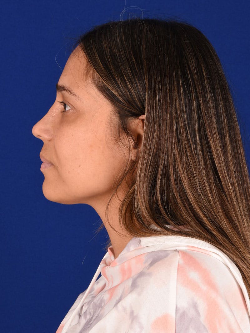 Female Rhinoplasty Before & After Gallery - Patient 261732 - Image 6