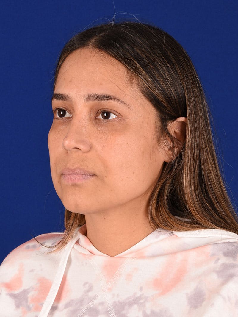 Female Rhinoplasty Before & After Gallery - Patient 261732 - Image 4