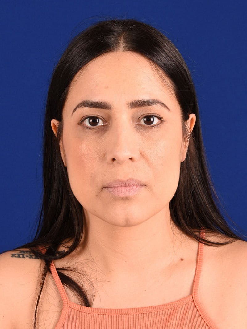 Female Rhinoplasty Before & After Gallery - Patient 261732 - Image 1
