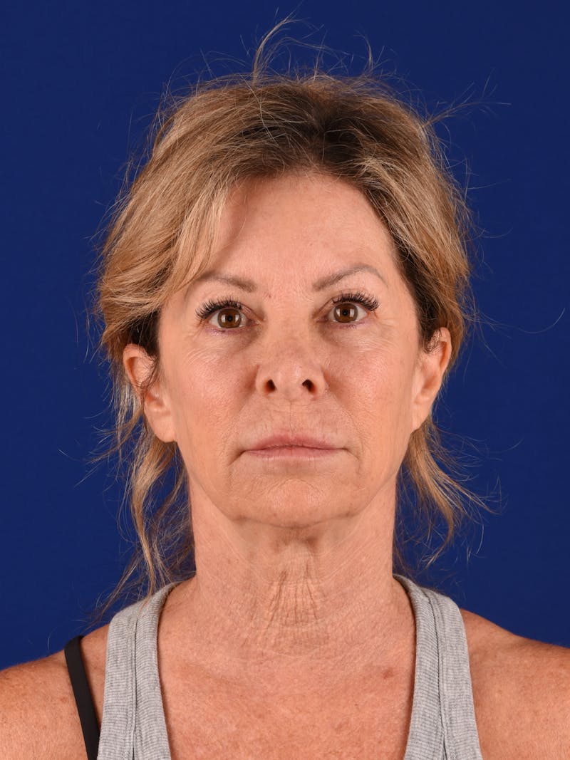 Facelift Before & After Gallery - Patient 699984 - Image 1