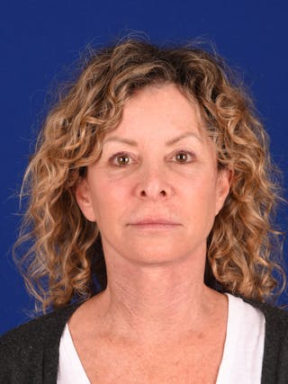 Facelift Before & After Gallery - Patient 699984 - Image 2