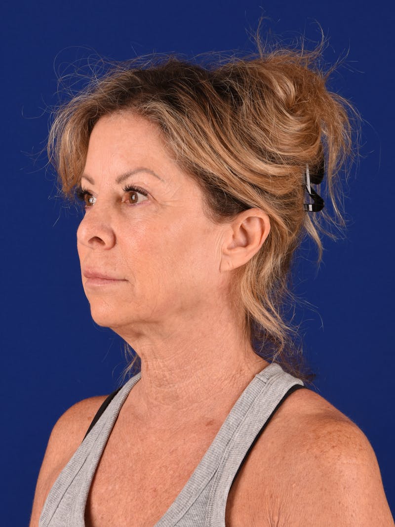 Facelift Before & After Gallery - Patient 699984 - Image 3