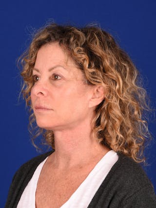 Facelift Before & After Gallery - Patient 699984 - Image 4