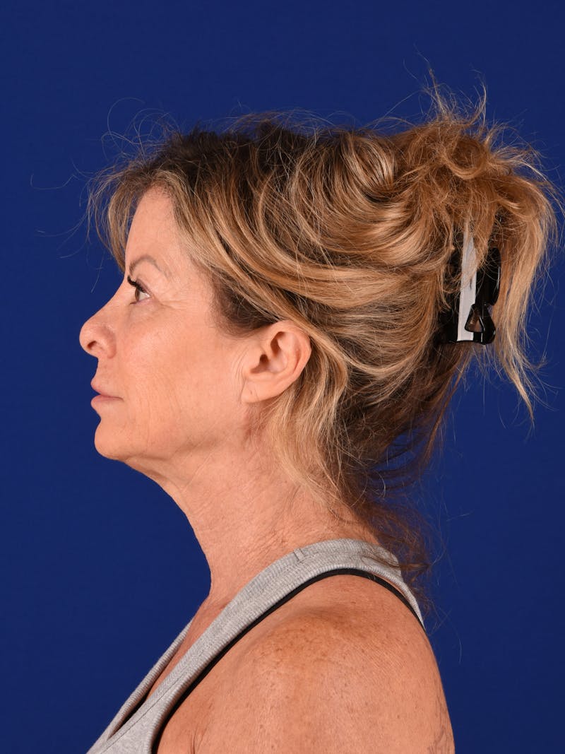 Facelift Before & After Gallery - Patient 699984 - Image 5