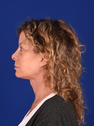 Facelift Before & After Gallery - Patient 699984 - Image 6