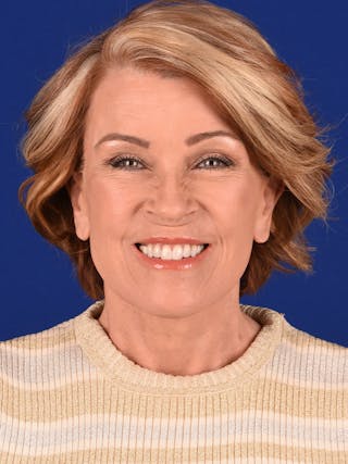 Facelift Before & After Gallery - Patient 162082285 - Image 4