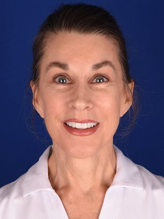 Facelift Before & After Gallery - Patient 196216 - Image 4